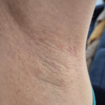 Yves Rocher Roll On Alerjisi: Ciddi Cilt Sorunu Yaşadık