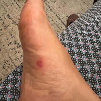 Birkenstock Terlik Ayağımı Yaraladı, İade Talebim Reddedildi