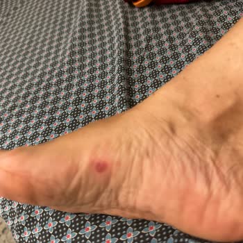 Birkenstock Terlik Ayağımı Yaraladı, İade Talebim Reddedildi