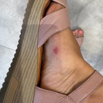 Birkenstock Terlik Ayağımı Yaraladı, İade Talebim Reddedildi