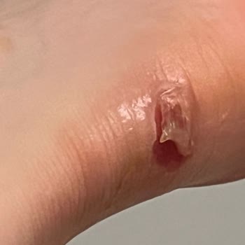 Yeni Alınan Ayakkabının Topukta Yaraya Sebep Olması Ve İade Talebine Olumsuz Yaklaşım