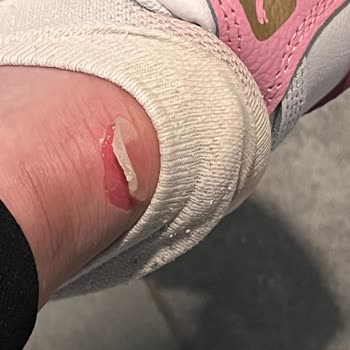 Yeni Alınan Ayakkabının Topukta Yaraya Sebep Olması Ve İade Talebine Olumsuz Yaklaşım