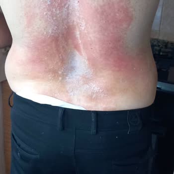 Tüy Dökücü Krem Ciddi Yanıklara Sebep Oldu, Tatilim Mahvoldu