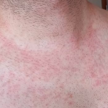 Tüy Dökücü Krem Ciddi Yanıklara Sebep Oldu, Tatilim Mahvoldu