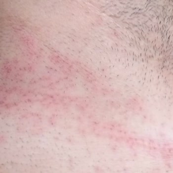 Tüy Dökücü Krem Ciddi Yanıklara Sebep Oldu, Tatilim Mahvoldu