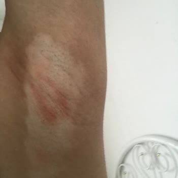 Yves Rocher Roll-on Son Kullanımlarda Ciltte Şişlik Ve Kızarıklık Yaptı