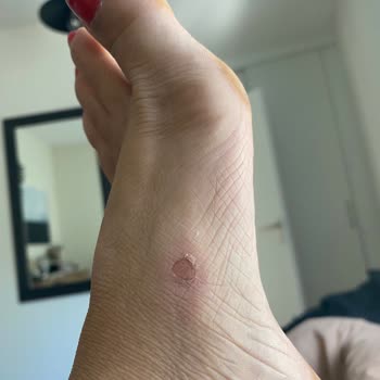 Satın Aldığım Crocs Terlik Ayağımı Yaraladı, Mağduriyetim Giderilmedi