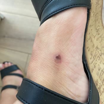 Satın Aldığım Crocs Terlik Ayağımı Yaraladı, Mağduriyetim Giderilmedi