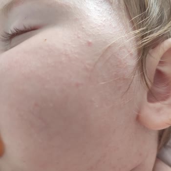 Mustela Şampuan Ve Kremi Bebeğimde Kızarıklık Ve Faydasızlık Yarattı