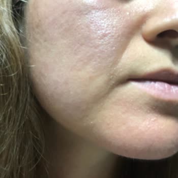 I Had a Severe Skin Reaction to Neutrogena Acne Face Wash After Just Two Uses