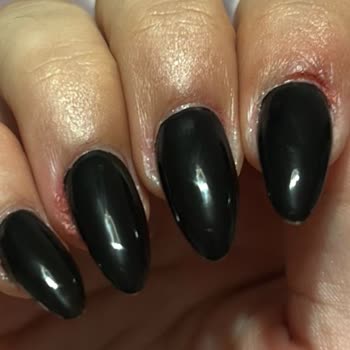 Manikür Sonrası Ciddi Yanık Ve İlgisiz Yaklaşım