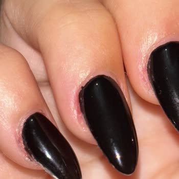 Manikür Sonrası Ciddi Yanık Ve İlgisiz Yaklaşım