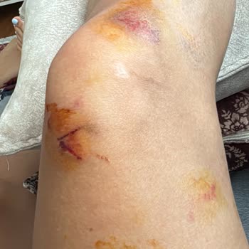 Acil Serviste İlgisizlik Ve İhmal Nedeniyle Mağduriyet Yaşadım