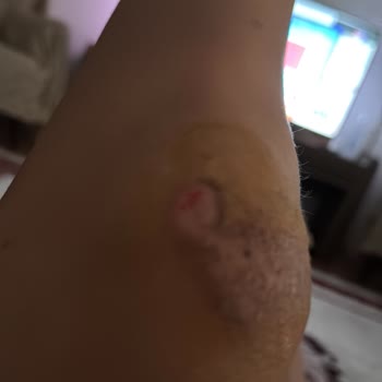 Acil Serviste İlgisizlik Ve İhmal Nedeniyle Mağduriyet Yaşadım