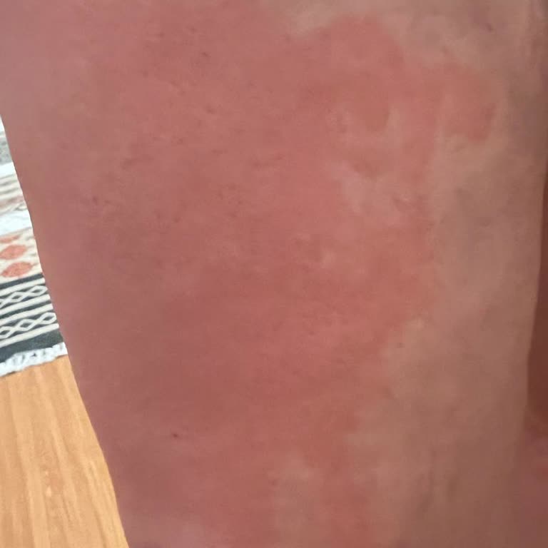 Krem Kullanımı Sonrası Şiddetli Cilt Reaksiyonu Ve Endişe