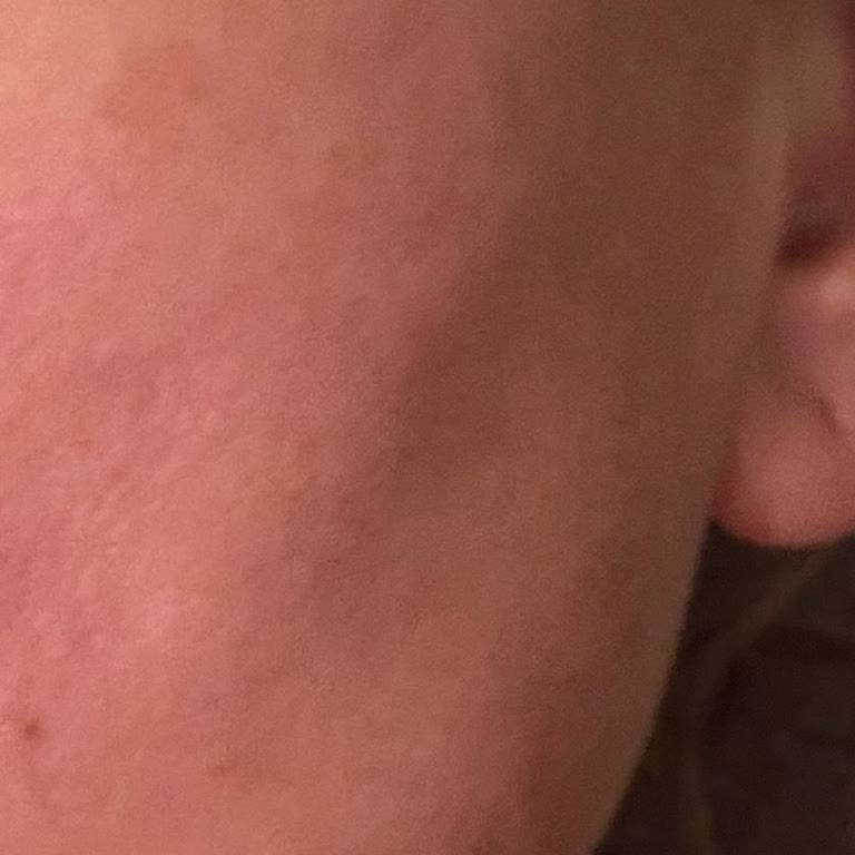 Medik8 Yeni Aldığım Ürün Cildimde Yanma Ve Leke Yaptı!