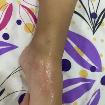 Sinek İlacı Etkisiz Kaldı Çocuğum Sineklerden Rahatsız Oldu