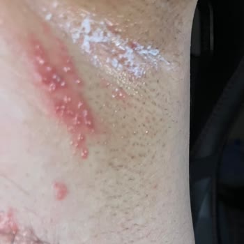 Rexona Deodorant Kullanımı Sonrası Ciltte Ciddi Tahriş Ve Sağlık Sorunları