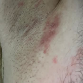 Rexona Deodorant Kullanımı Sonrası Ciltte Ciddi Tahriş Ve Sağlık Sorunları