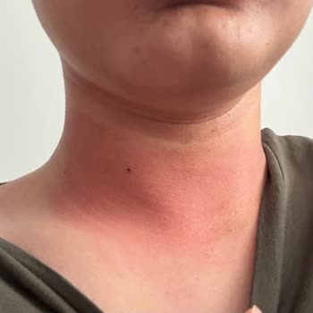 Bargello 561 Kodlu Parfüm Cildimde Alerjik Reaksiyona Sebep Oldu