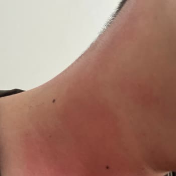 Bargello 561 Kodlu Parfüm Cildimde Alerjik Reaksiyona Sebep Oldu