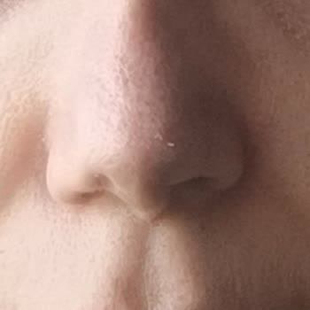 Burnumda Ameliyat Sonrası Sorunlar Ve Ek Ücret Talebi