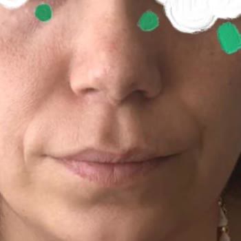 Burnumda Ameliyat Sonrası Sorunlar Ve Ek Ücret Talebi