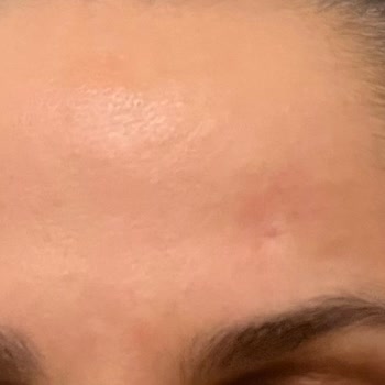 Mezoterapi Sonrası Ciltte Kalıcı İz Ve Mağduriyet