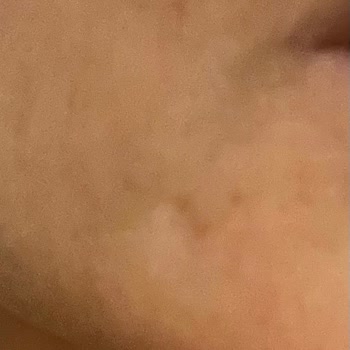 Mezoterapi Sonrası Ciltte Kalıcı İz Ve Mağduriyet