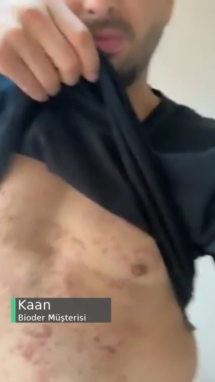 Bioder Tüy Dökücü Kremi Cildimi Mahvetti! videonun kapak resmi
