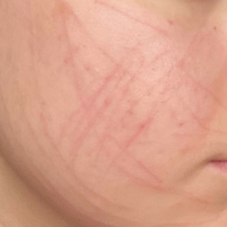 Medikal Cilt Bakımında Beklenmeyen Sonuçlar Ve Eksik Uygulama