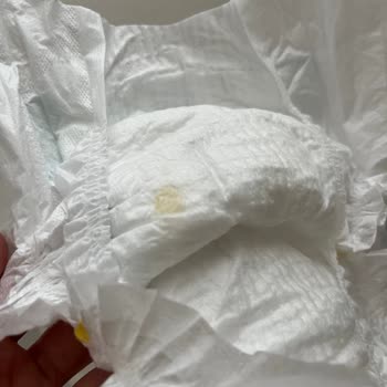 Molfix Bebek Bezinden Çıkan Yabancı Madde Şoku