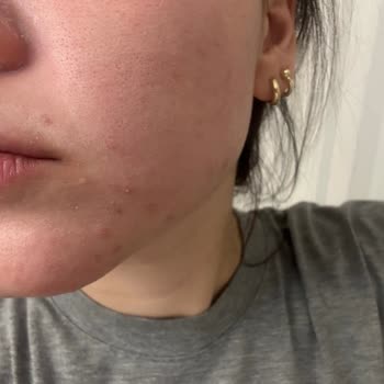 I Used Neutrogena Acne Plus Set and It Burned My Skin with Redness and Breakouts