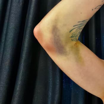 Medicana Sağlık Grubu Hatalı Kan Alma Sonucu Kolumda Ciddi Sağlık Sorunları Ve İş Kaybı Yaşadım