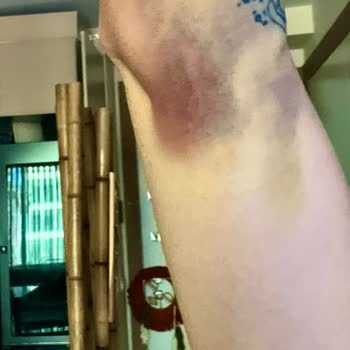 Medicana Sağlık Grubu Hatalı Kan Alma Sonucu Kolumda Ciddi Sağlık Sorunları Ve İş Kaybı Yaşadım