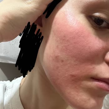 Ciltte Yanma Ve Şişlik Yapan Serum İçin Destek Talebi