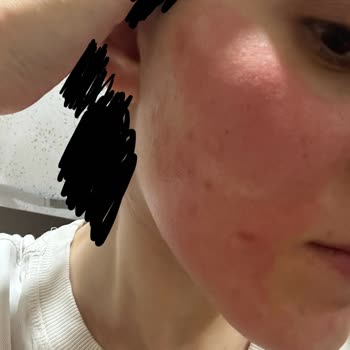 Ciltte Yanma Ve Şişlik Yapan Serum İçin Destek Talebi