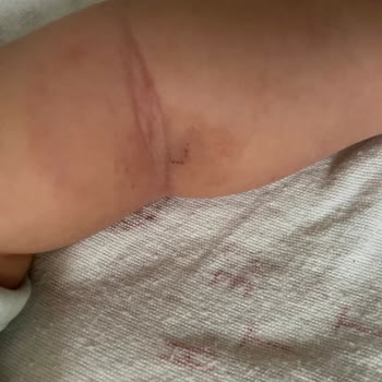 Bebeğime Kan Alımı Sırasında Yaşanan Bilinçsiz Ve Acı Verici Müdahale