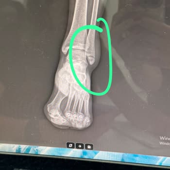 Sağlık Nedeniyle Katılamadığım Uçuşun Bilet Ücretinin İade Edilmemesi