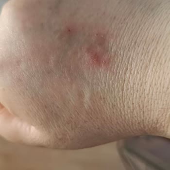 Solante Güneş Kremi Etkisiz Ve Ciltte Tahriş Yaptı