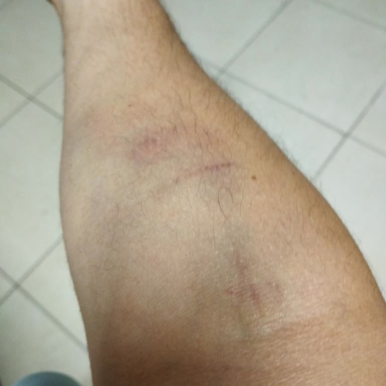 Türk Kızılay Kan Alma Sonrası Kolum Mosmor Ve Şişti Dönüş Bekliyorum