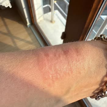 Aldığım Guess Saat Alerji Yaptı, Orijinalliğinden Şüpheliyim