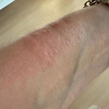 Aldığım Guess Saat Alerji Yaptı, Orijinalliğinden Şüpheliyim