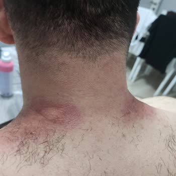 Agiss Tüy Dökücü Cildimde Alerji Ve Yanık Yaptı