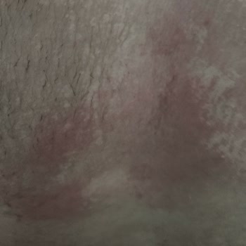 Agiss Tüy Dökücü Cildimde Alerji Ve Yanık Yaptı