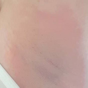 Yves Rocher Roll-on Sonrası Geçmeyen Kaşıntı Ve Kızarıklık Sorunu