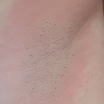 Yves Rocher Roll-on Sonrası Geçmeyen Kaşıntı Ve Kızarıklık Sorunu