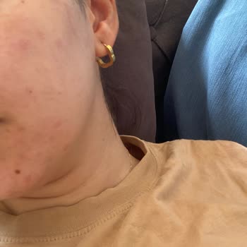 Cilt Bakımı Sonrası Yüzümde Kızarıklık Ve Yağ Bezeleri Oluştu