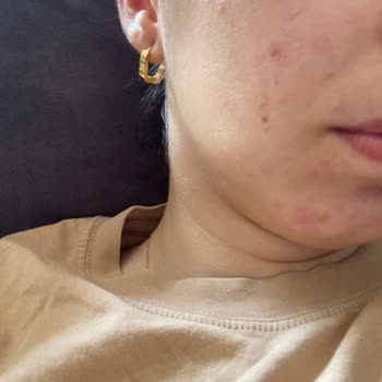 Cilt Bakımı Sonrası Yüzümde Kızarıklık Ve Yağ Bezeleri Oluştu