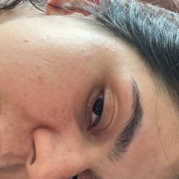 Cilt Bakımı Sonrası Yüzümde Kızarıklık Ve Yağ Bezeleri Oluştu